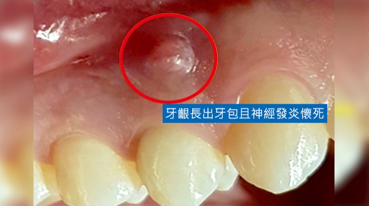 牙齿疼痛可能是细菌再次入侵牙根