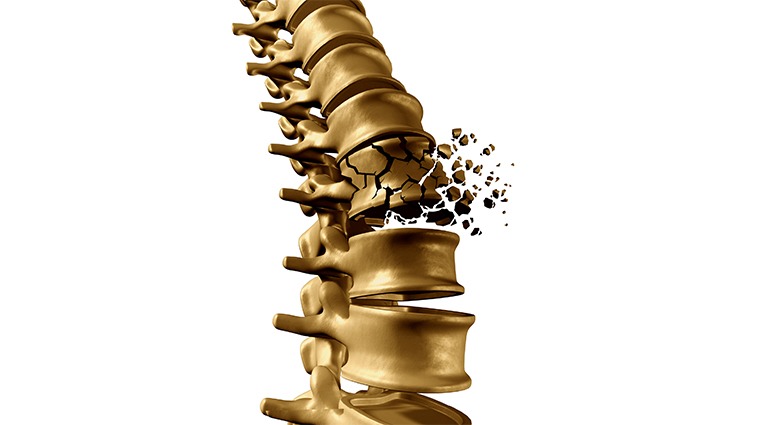 脊椎壓迫性骨折