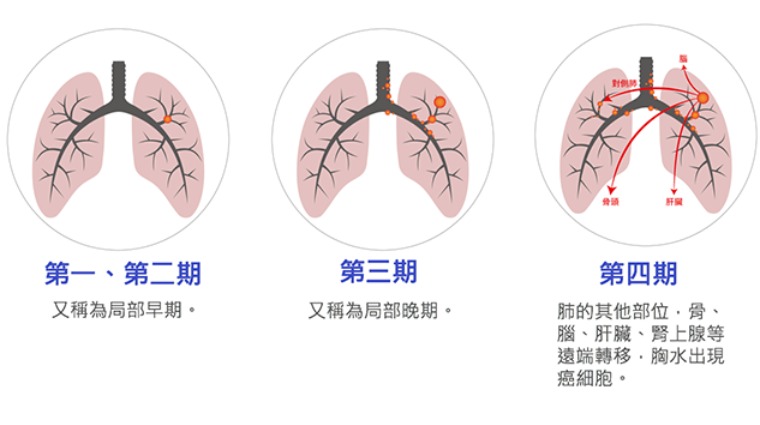 肺癌分期