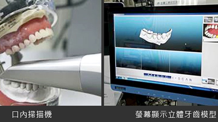 口內掃描機取模做假牙 口內掃描機取模做假牙