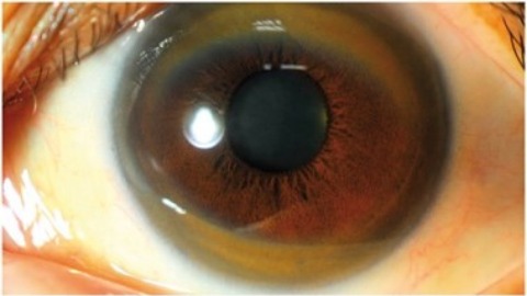 威爾森氏症病患眼睛出現棕色環