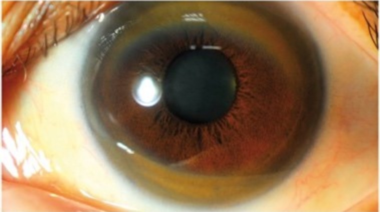 威爾森氏症病患眼睛出現棕色環