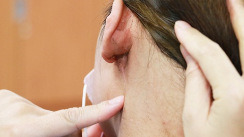 患者耳下腮腺腫瘤經手術後傷口恢復良好