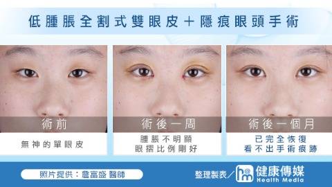 低腫脹全割式雙眼皮+隱痕眼頭手術