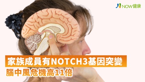 家族成員有NOTCH3基因突變 腦中風危機高11倍
