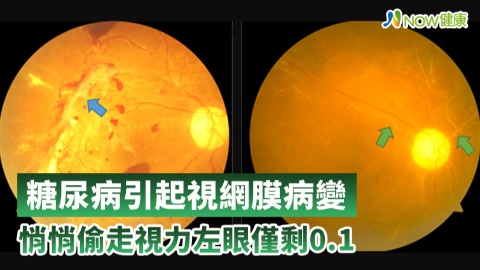 糖尿病引起視網膜病變 悄悄偷走視力僅剩0.1