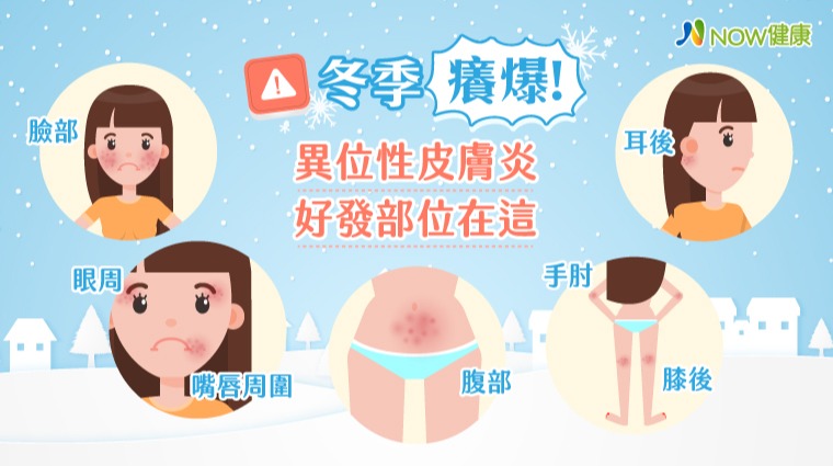 异位性皮肤炎盛行于冬季 尤其这几个部位特别容易发作