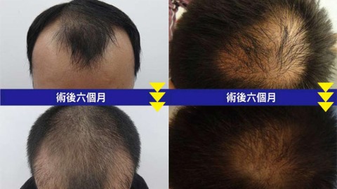 植髮不必掀頭皮 新技術大幅提升毛囊存活率