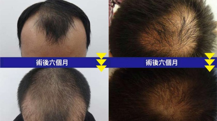 植髮不必掀頭皮 新技術大幅提升毛囊存活率