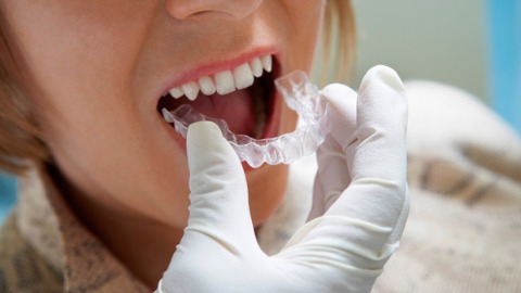 植牙搭配數位隱形牙套 提高手術成功率