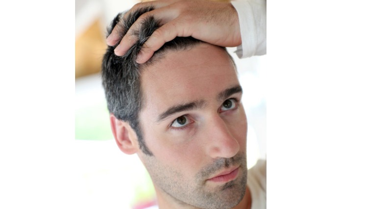植髮改善圓形禿髮量 根本治療應採免疫調節