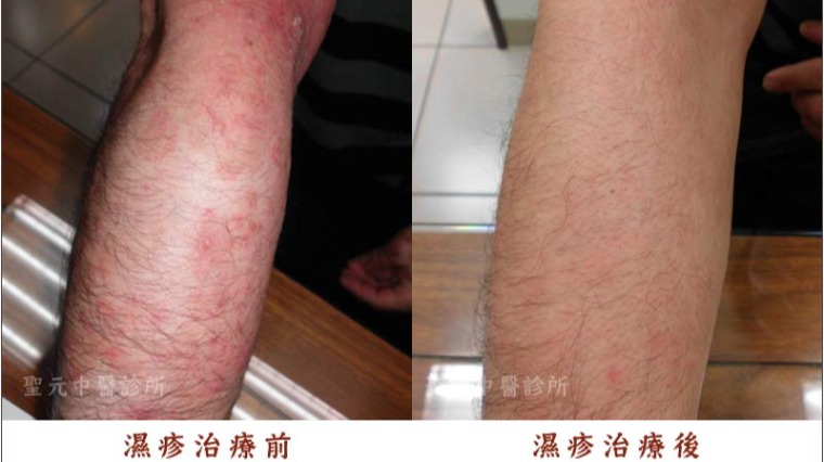 季節交替濕疹患者增 中醫調理根除紅疹 季節交替濕疹患者增 中醫調理根除紅疹