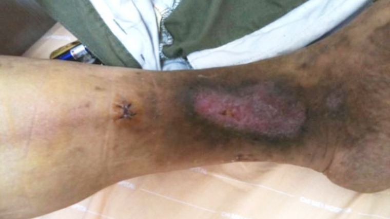 腳踝抓傷久不癒合 竟罹下肢靜脈潰瘍 腳踝抓傷久不癒合 竟罹下肢靜脈潰瘍