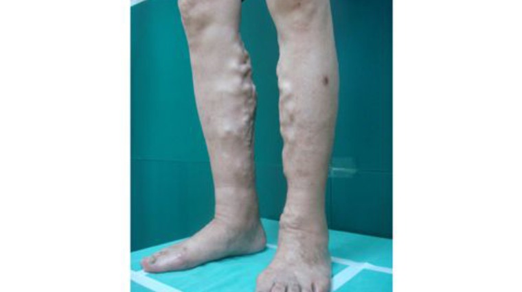 「浮腳筋」放任不管 恐罹蜂窩性組織 「浮腳筋」放任不管 恐罹蜂窩性組織