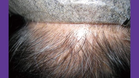 金卡達夏禿變難啟齒 髮片造型反釀毛囊發炎