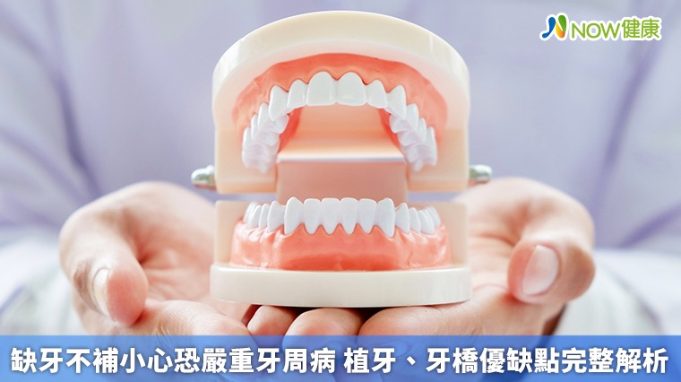 缺牙不補小心恐嚴重牙周病 植牙、牙橋優缺點完整解析