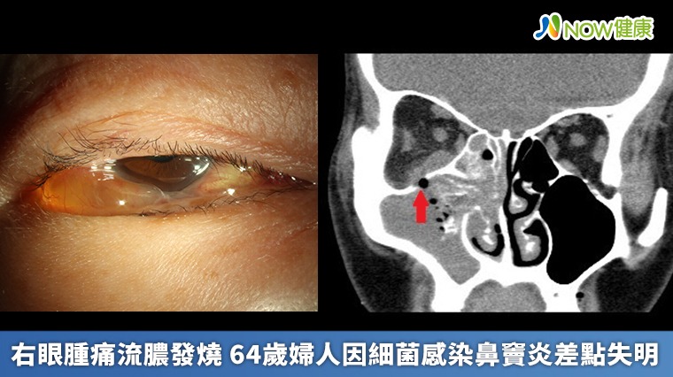  右眼腫痛流膿發燒 64歲婦人因細菌感染鼻竇炎差點失明