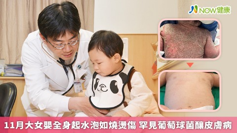 11月大女嬰全身起水泡如燒燙傷 罕見葡萄球菌釀皮膚病
