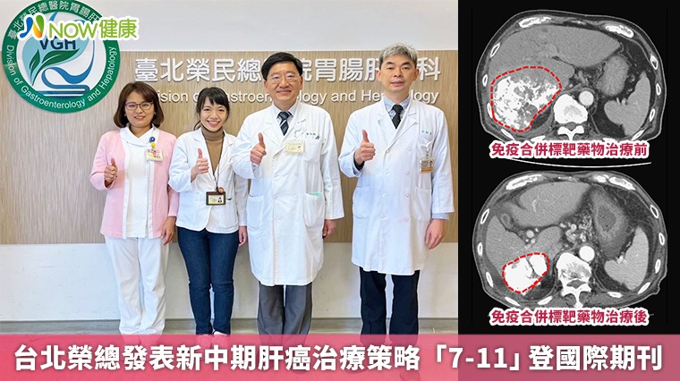 台北榮總發表新中期肝癌治療策略 「7-11」登國際期刊
