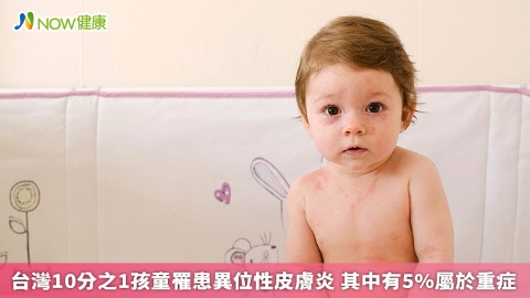 台灣10分之1孩童罹患異位性皮膚炎 其中有5%屬於重症