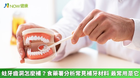 蛀牙齒洞怎麼補？食藥署分析常見補牙材料 最常用是它