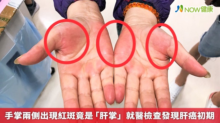 手掌兩側出現紅斑竟是「肝掌」 就醫檢查發現肝癌初期
