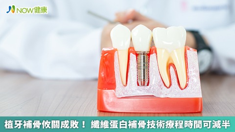 植牙補骨攸關成敗！ 纖維蛋白補骨技術療程時間可減半