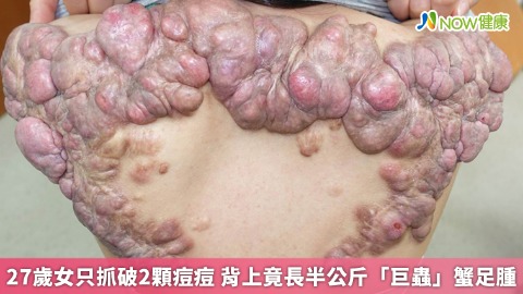 27歲女只抓破2顆痘痘 背上竟長半公斤「巨蟲」蟹足腫