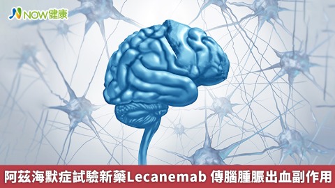 阿茲海默症試驗新藥Lecanemab 傳腦腫脤出血副作用
