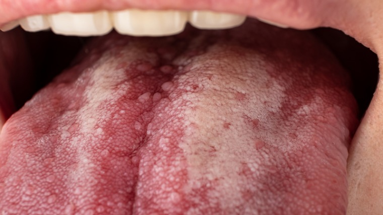 口腔內出現白斑不痛不癢 半年後檢查竟發現「這種癌」