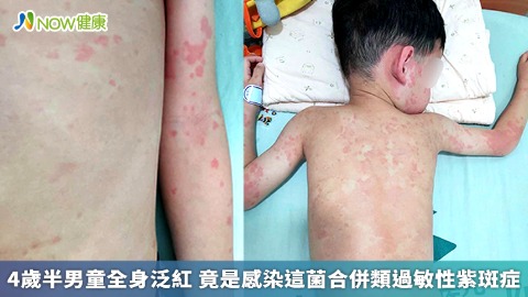 4歲半男童全身泛紅 竟是感染這菌合併類過敏性紫斑症