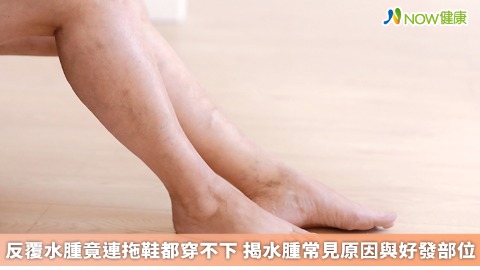 反覆水腫竟連拖鞋都穿不下 揭水腫常見原因與好發部位 