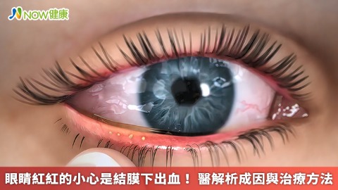 眼睛紅紅的小心是結膜下出血！ 醫解析成因與治療方法