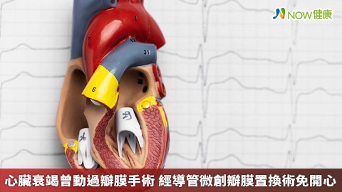 心臟衰竭曾動過瓣膜手術 經導管微創瓣膜置換術免開心