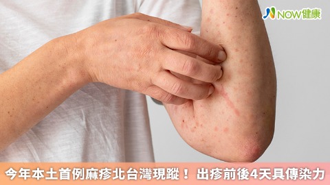今年本土首例麻疹北台灣現蹤！ 出疹前後4天具傳染力
