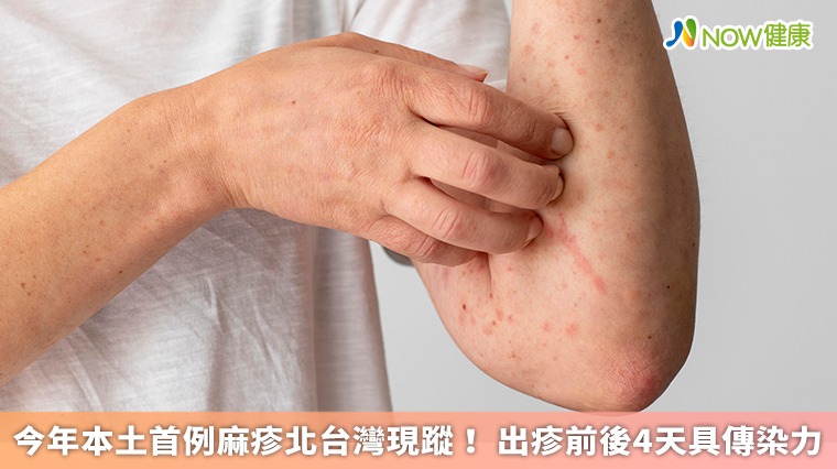 今年本土首例麻疹北台灣現蹤！ 出疹前後4天具傳染力