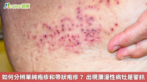 如何分辨單純疱疹和帶狀疱疹？ 出現瀰漫性病灶是警訊