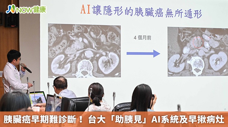 胰臟癌早期難診斷! 台大「助胰見」AI系統及早揪病灶 胰臟癌早期難診斷! 台大「助胰見」AI系統及早揪病灶