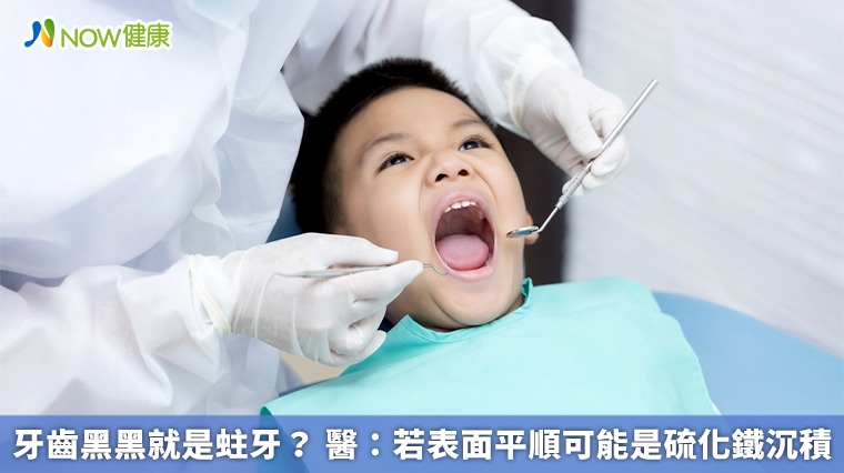 牙齒黑黑就是蛀牙？ 醫：若表面平順可能是硫化鐵沉積