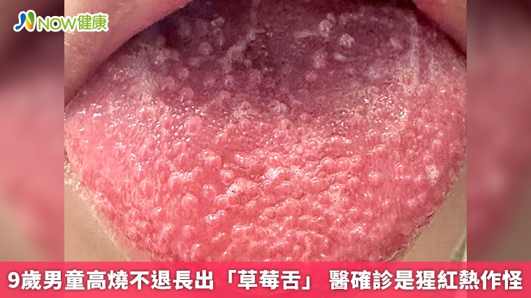 9歲男童高燒不退長出「草莓舌」 醫確診是猩紅熱作怪 9歲男童高燒不退長出「草莓舌」 醫確診是猩紅熱作怪