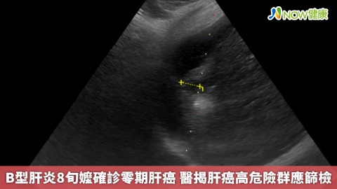 B型肝炎8旬嬤確診零期肝癌 醫揭肝癌高危險群應篩檢 B型肝炎8旬嬤確診零期肝癌 醫揭肝癌高危險群應篩檢
