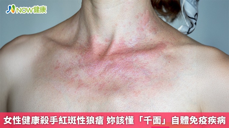 女性健康殺手紅斑性狼瘡 妳該懂「千面」自體免疫疾病 女性健康殺手紅斑性狼瘡 妳該懂「千面」自體免疫疾病