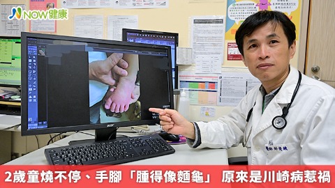 2歲童燒不停、手腳「腫得像麵龜」 原來是川崎病惹禍 2歲童燒不停、手腳「腫得像麵龜」 原來是川崎病惹禍