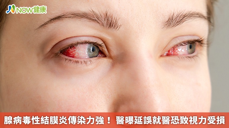 腺病毒性結膜炎傳染力強! 醫曝延誤就醫恐致視力受損 腺病毒性結膜炎傳染力強! 醫曝延誤就醫恐致視力受損