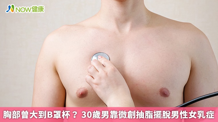 胸部曾大到B罩杯？ 30歲男靠微創抽脂擺脫男性女乳症