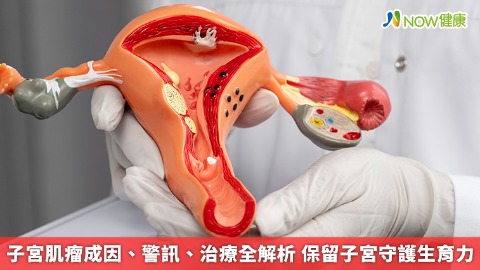 子宮肌瘤成因、警訊、治療全解析 保留子宮守護生育力