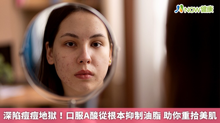 深陷痘痘地獄！口服A酸從根本抑制油脂 助你重拾美肌