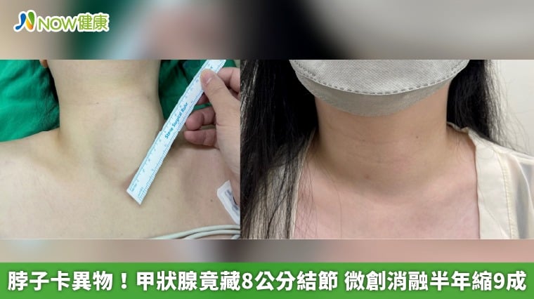 脖子卡異物！甲狀腺竟藏8公分結節 微創消融半年縮9成