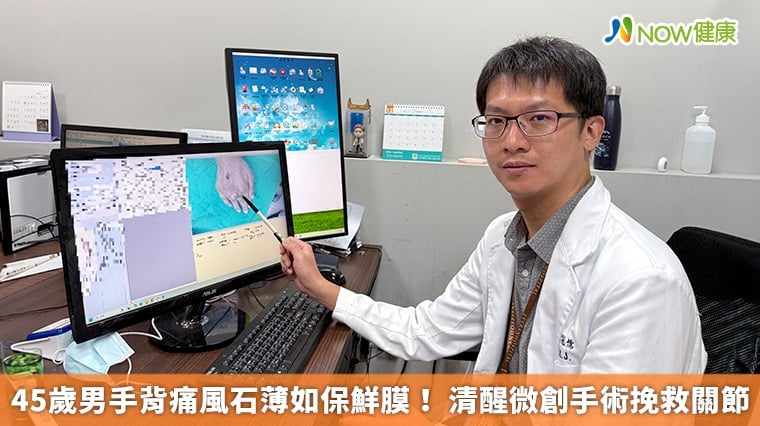 45歲男手背痛風石薄如保鮮膜！ 清醒微創手術挽救關節