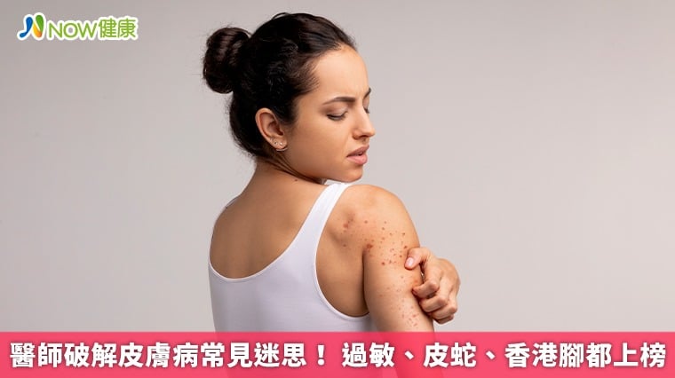 醫師破解皮膚病常見迷思！ 過敏、皮蛇、香港腳都上榜